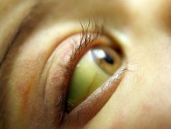 Гепатит А. Распознаем, боремся, избегаем заболевания. Гепатит А. Распознаем, боремся, избегаем заболевания.