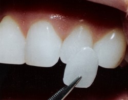 Как сохранить идеальную улыбку? Как сохранить идеальную улыбку?