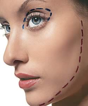 Подтяжка лица с помощью пластической операции