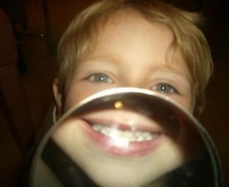 Исправления прикуса у детей