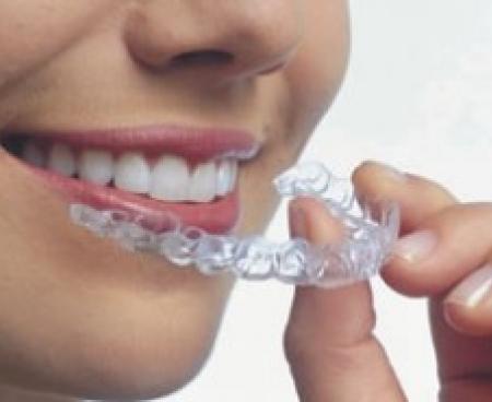 Внутренние брекеты